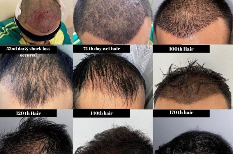 Hair Transplant Post-Op Aftercare: A Comprehensive Guide by Wellzone Clinic