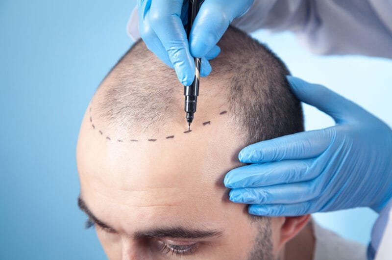 Hair Transplants in the UK
