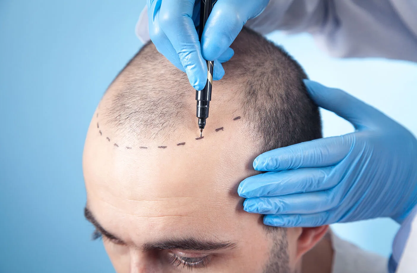 Hair Transplants in the UK