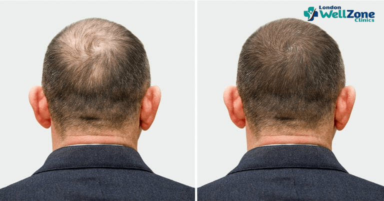 Hair Transplant Turkey vs UK: Why Choosing a UK Clinic May Be the Smarter Move