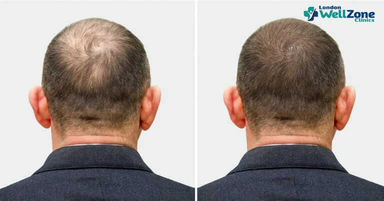 Hair Transplant Turkey vs UK: Why Choosing a UK Clinic May Be the Smarter Move